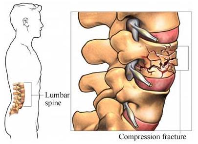 Bone article